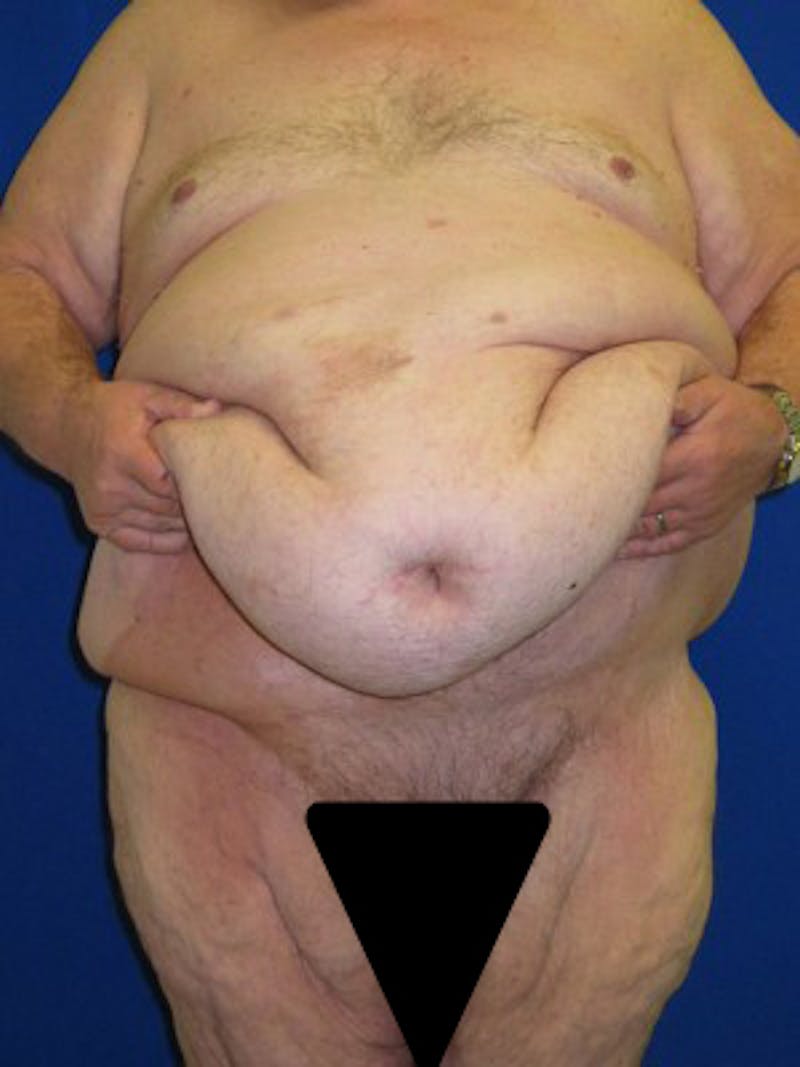 Panniculectomy Before & After Gallery - Patient 175169375 - Image 9