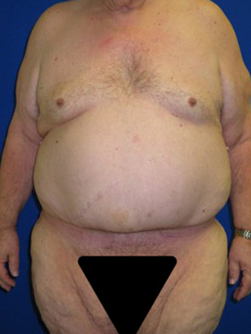 Panniculectomy Before & After Gallery - Patient 175169375 - Image 10