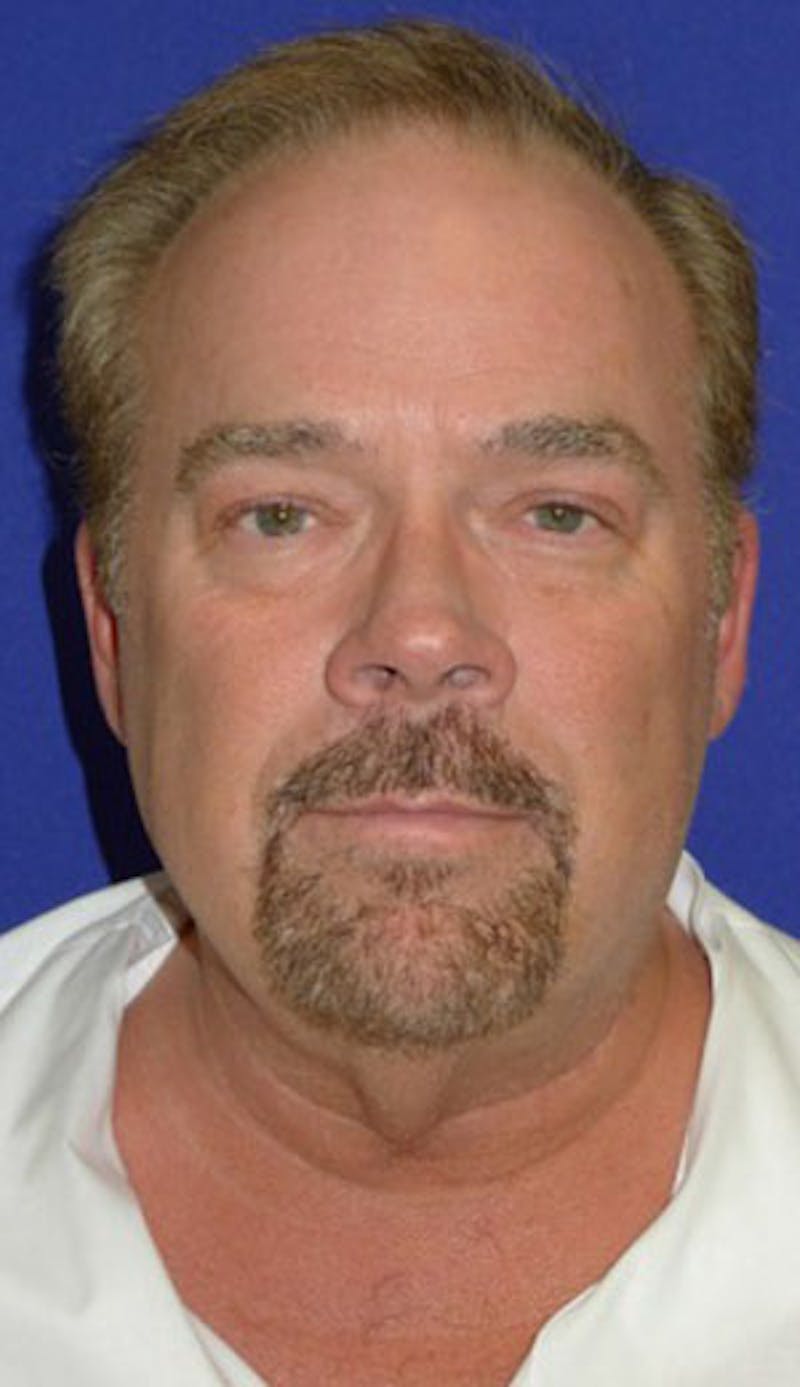 Facelift Before & After Gallery - Patient 175169381 - Image 1