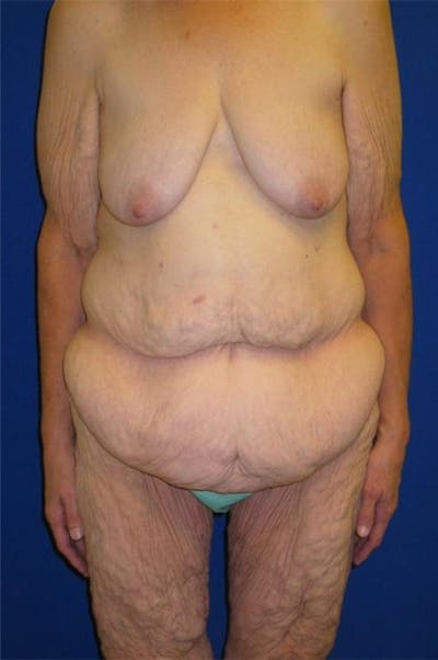 Panniculectomy Before & After Gallery - Patient 178935315 - Image 1