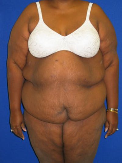 Panniculectomy Before & After Gallery - Patient 175169388 - Image 1