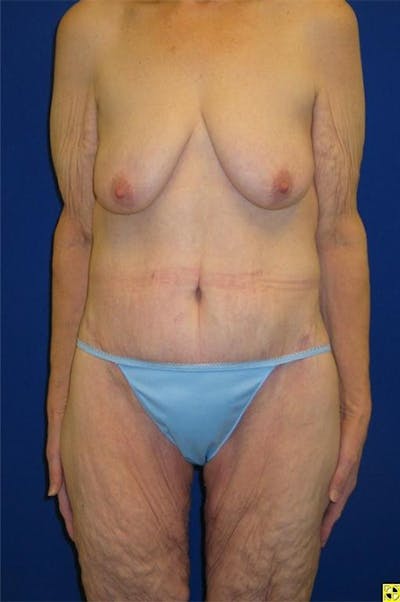 Panniculectomy Before & After Gallery - Patient 178935315 - Image 2
