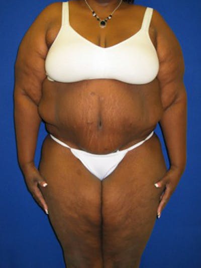 Panniculectomy Before & After Gallery - Patient 175169388 - Image 2