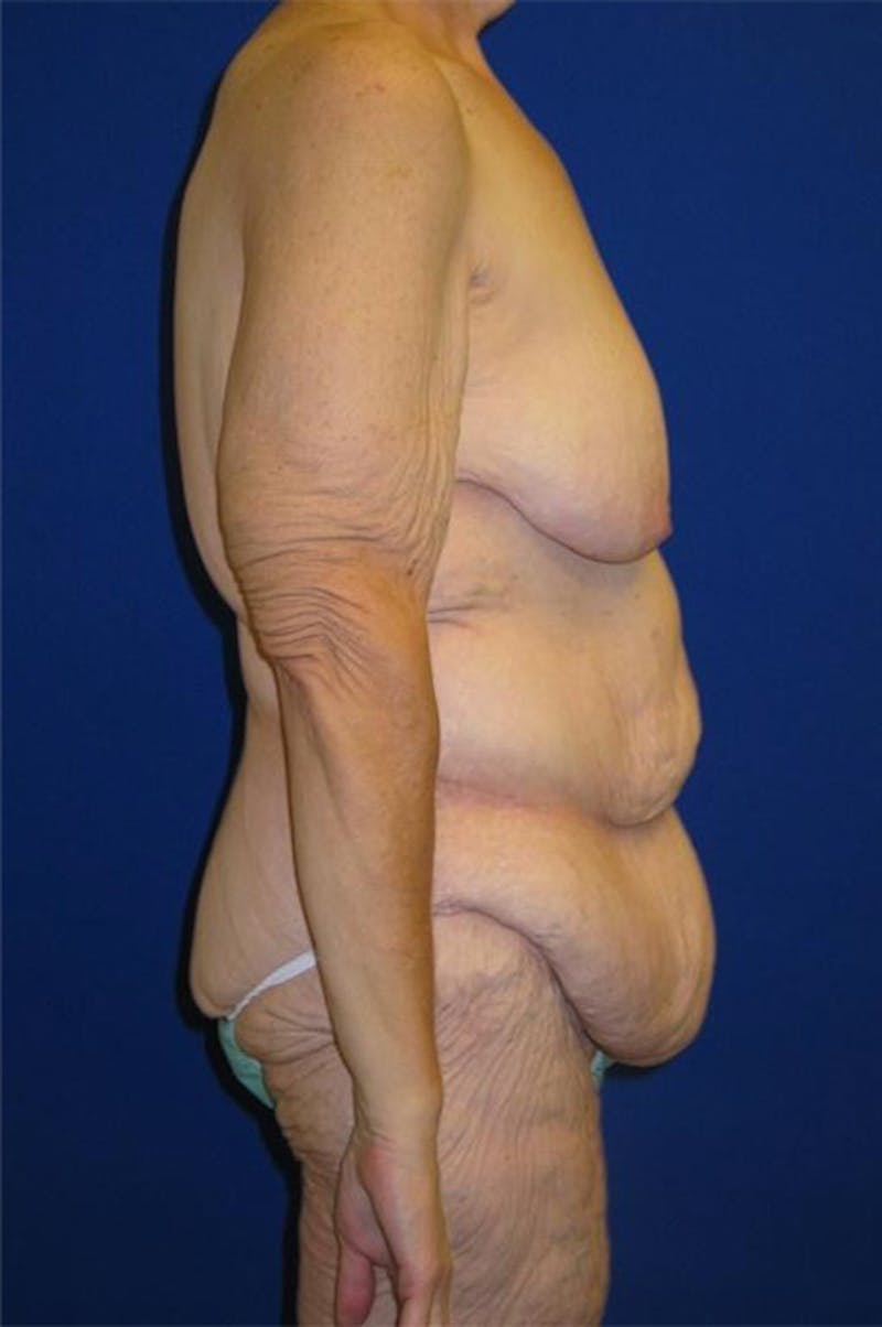 Panniculectomy Before & After Gallery - Patient 178935315 - Image 3
