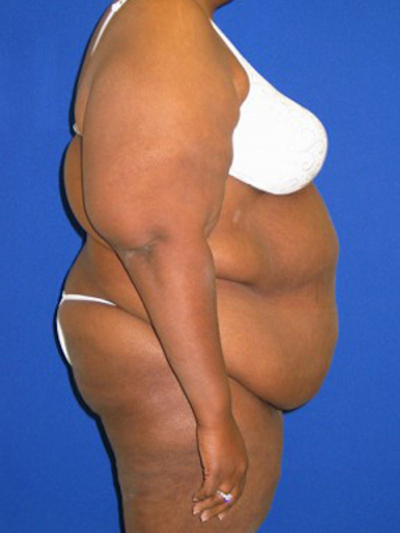 Panniculectomy Before & After Gallery - Patient 175169388 - Image 3