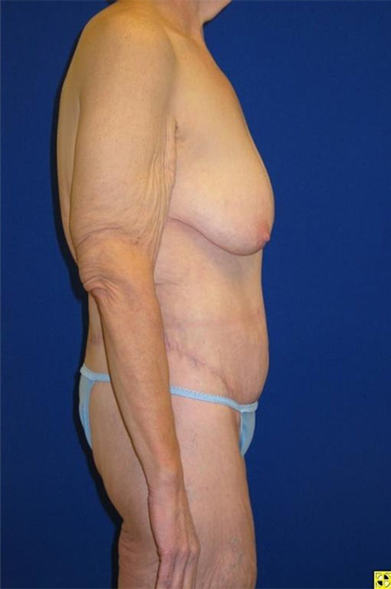 Panniculectomy Before & After Gallery - Patient 178935315 - Image 4