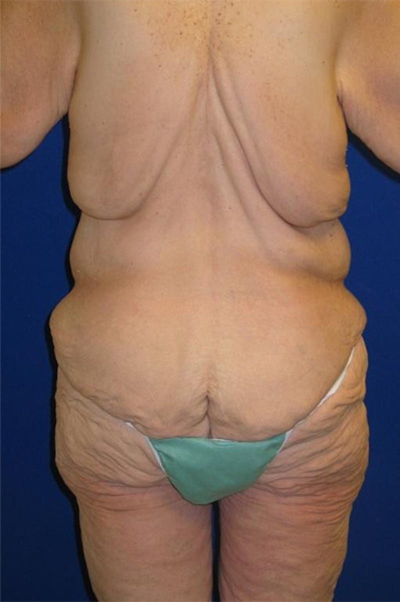 Panniculectomy Before & After Gallery - Patient 178935315 - Image 5