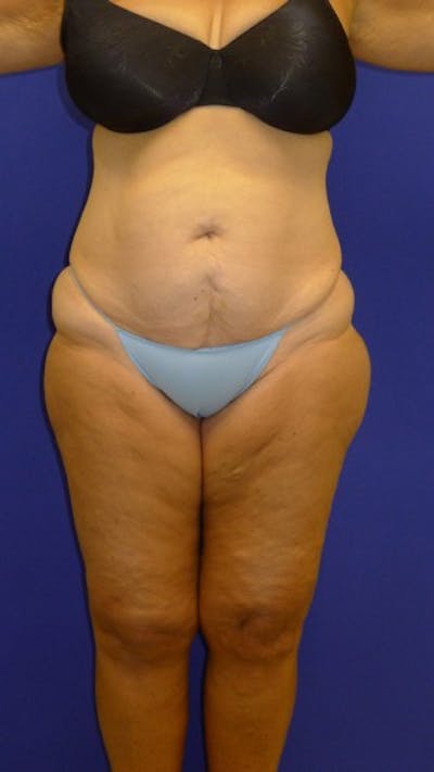 Liposuction Before & After Gallery - Patient 175169394 - Image 1