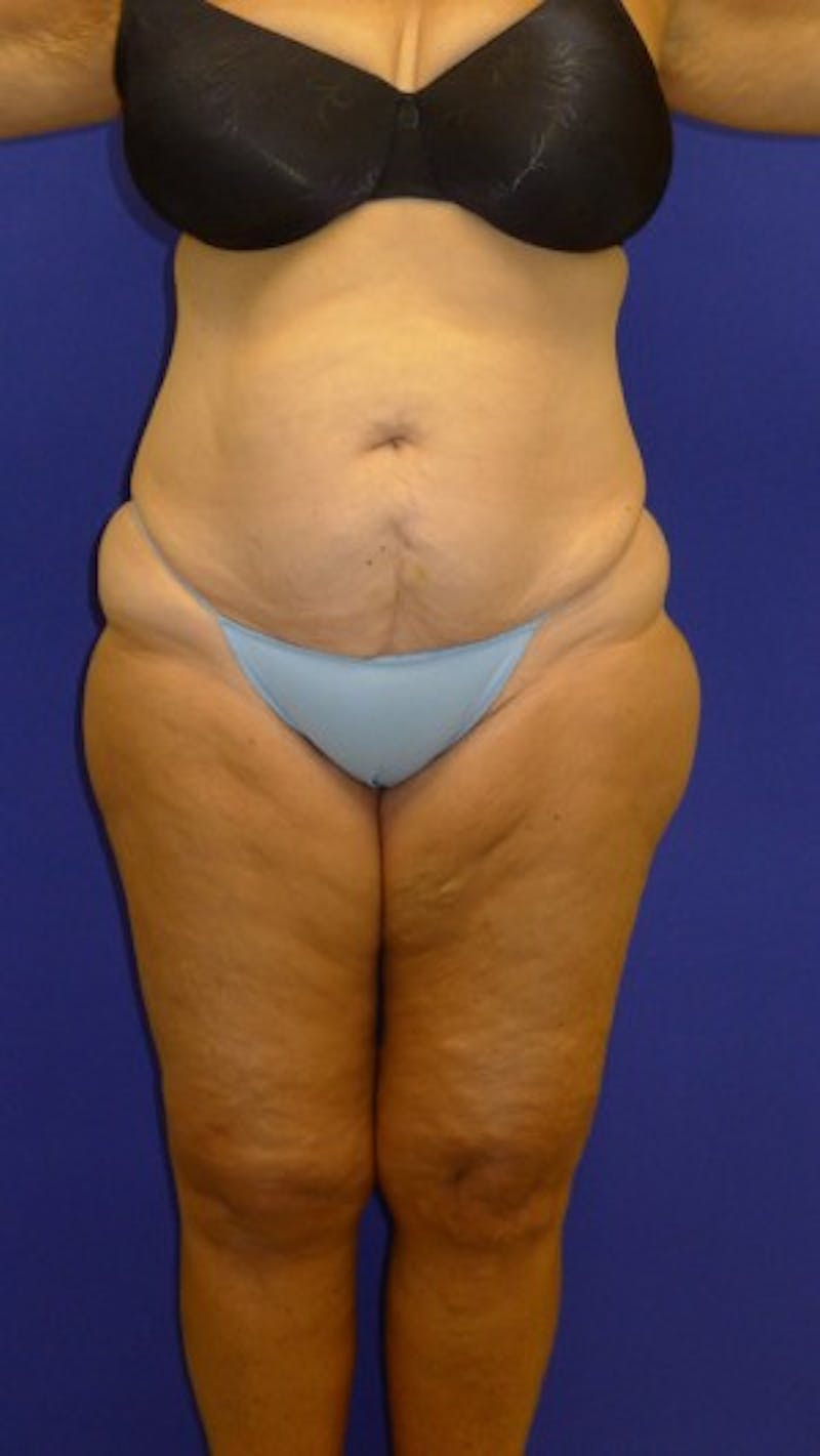 Liposuction Before & After Gallery - Patient 175169394 - Image 1