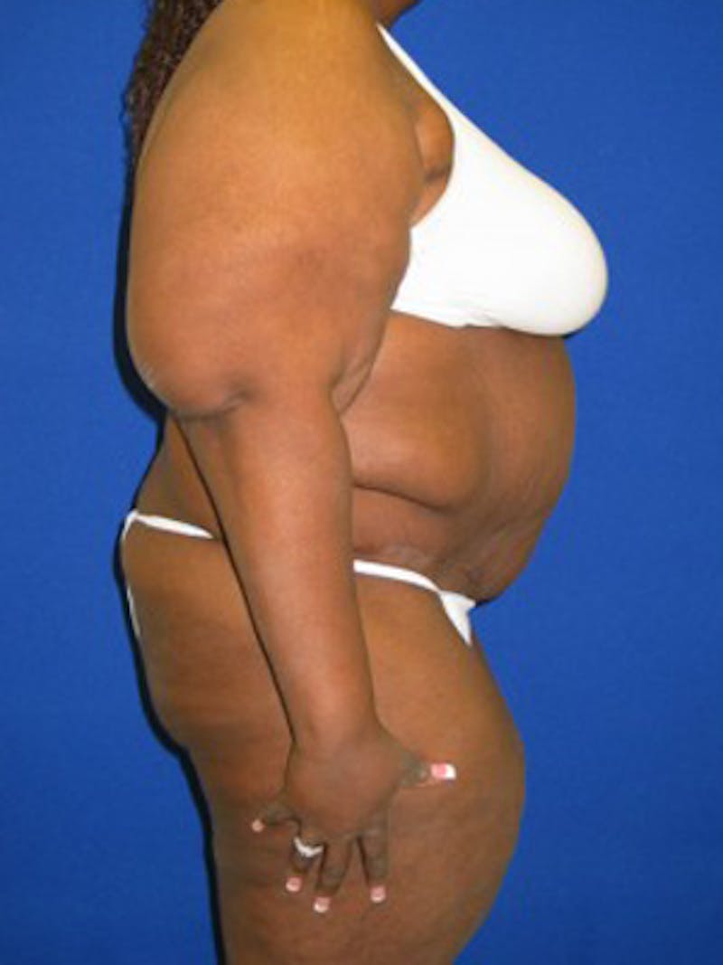 Panniculectomy Before & After Gallery - Patient 175169388 - Image 4