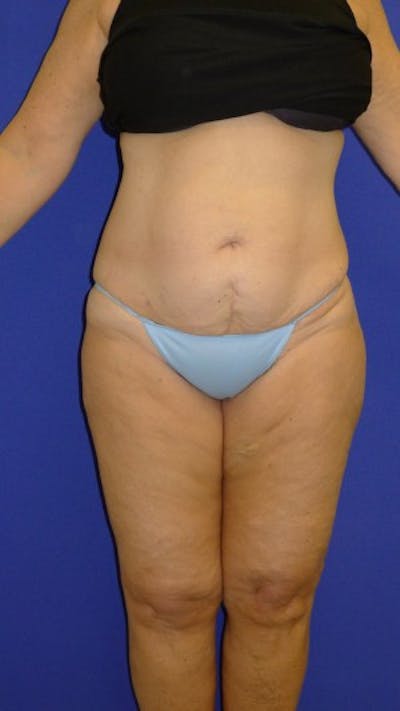 Liposuction Before & After Gallery - Patient 175169394 - Image 2
