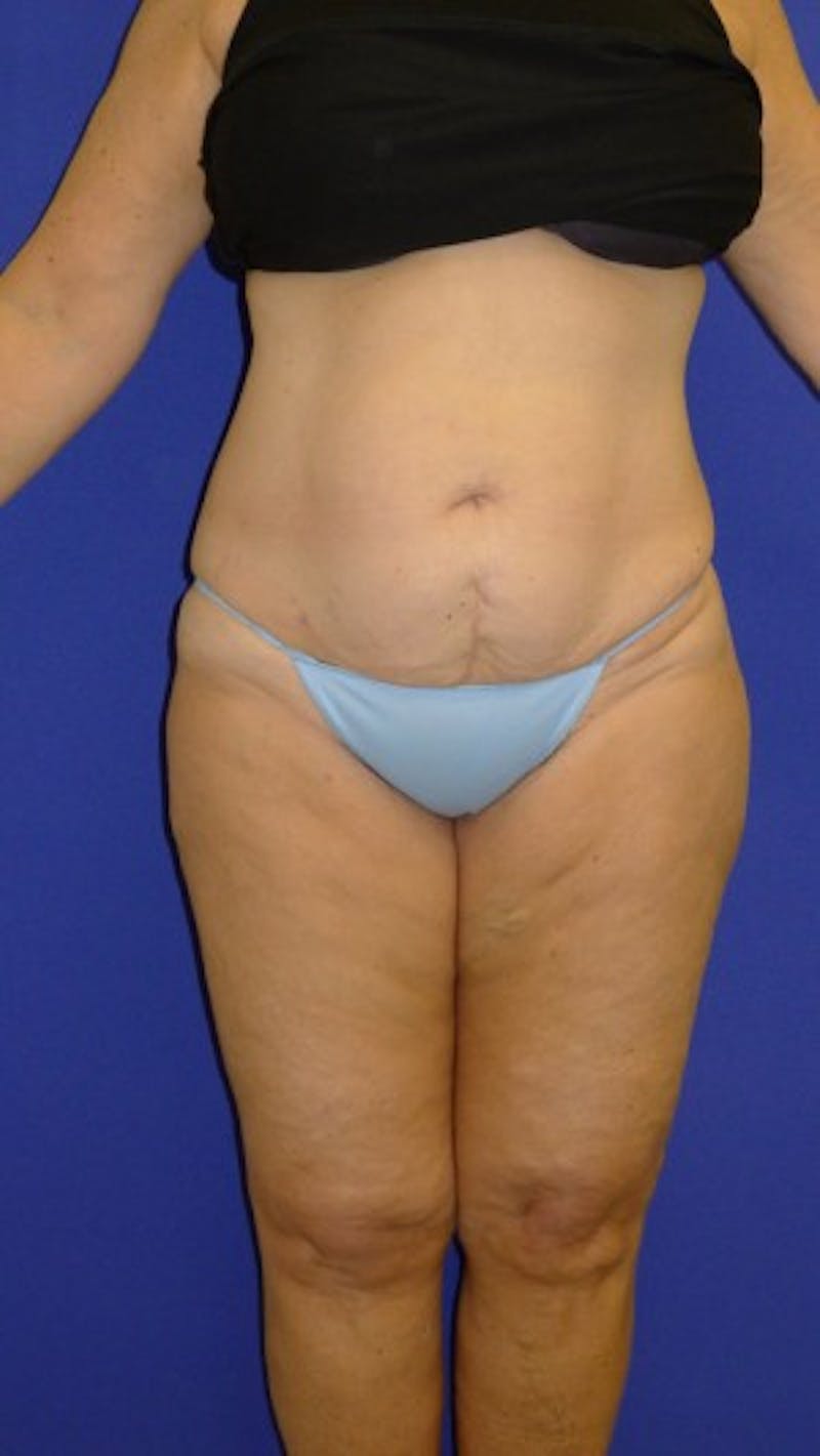 Liposuction Before & After Gallery - Patient 175169394 - Image 2