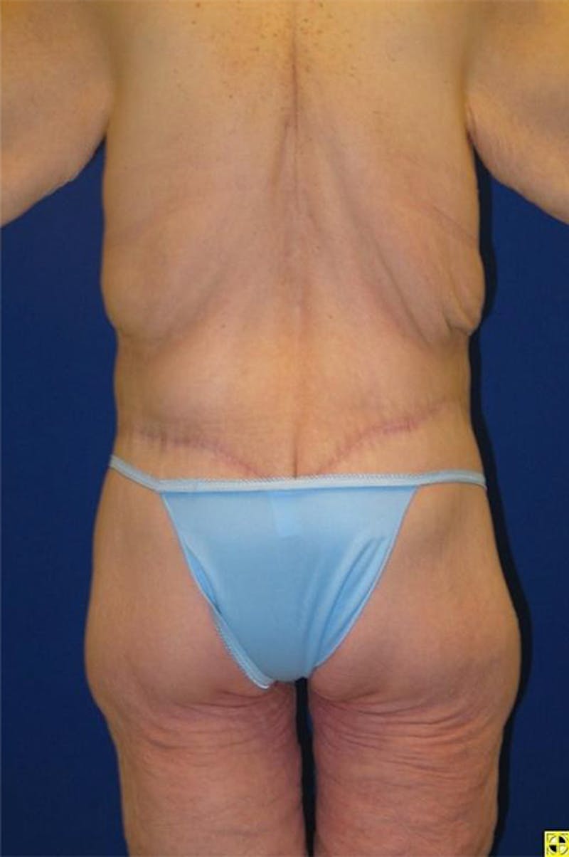 Panniculectomy Before & After Gallery - Patient 178935315 - Image 6