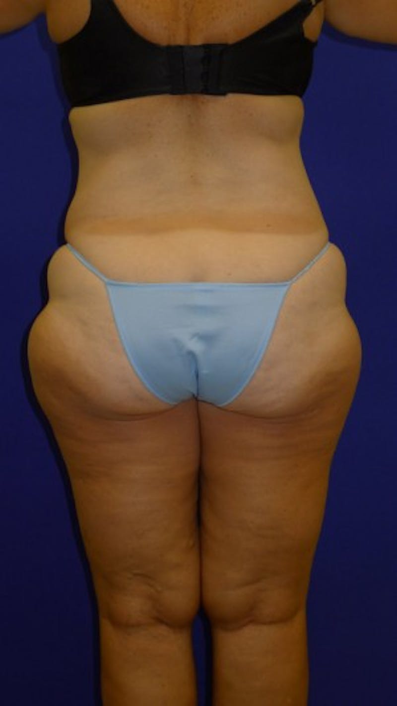 Liposuction Before & After Gallery - Patient 175169394 - Image 3