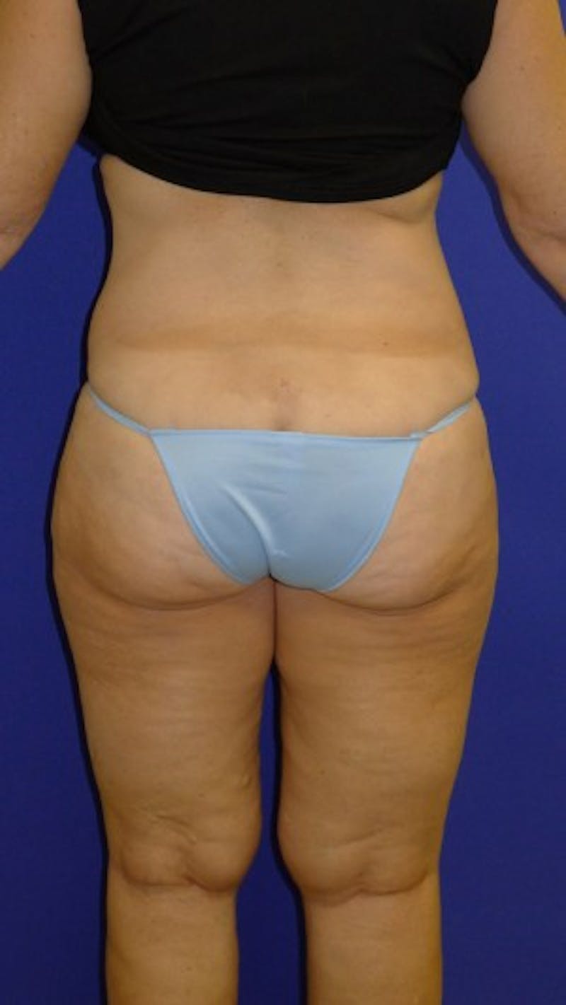 Liposuction Before & After Gallery - Patient 175169394 - Image 4