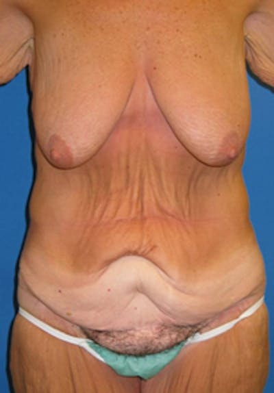 Circumferential Body Lift Before & After Gallery - Patient 175169406 - Image 1