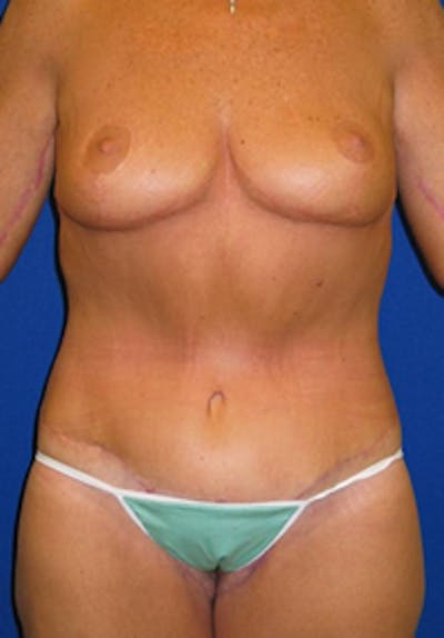 Circumferential Body Lift Before & After Gallery - Patient 175169406 - Image 2