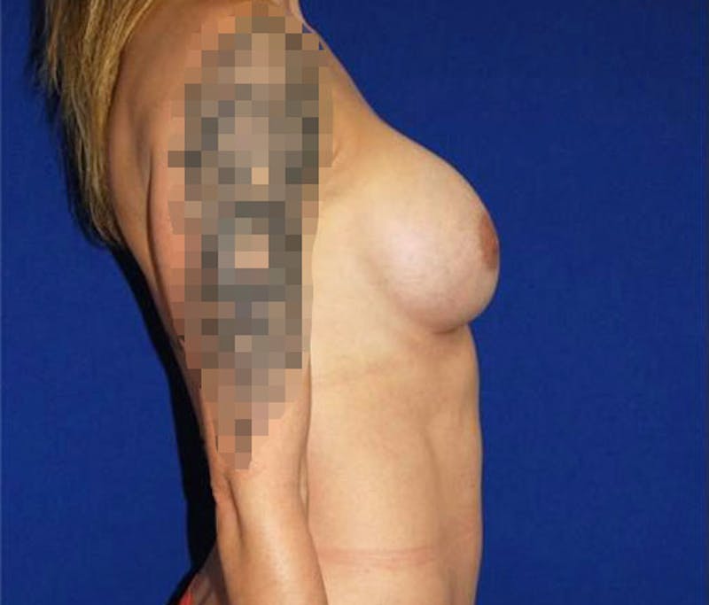Augmentation Before & After Gallery - Patient 175169402 - Image 4