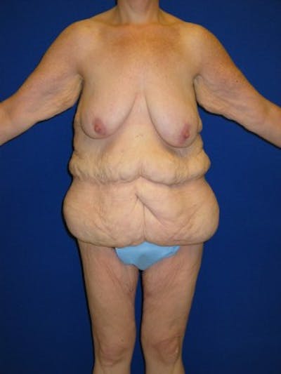 Panniculectomy Before & After Gallery - Patient 175169413 - Image 1