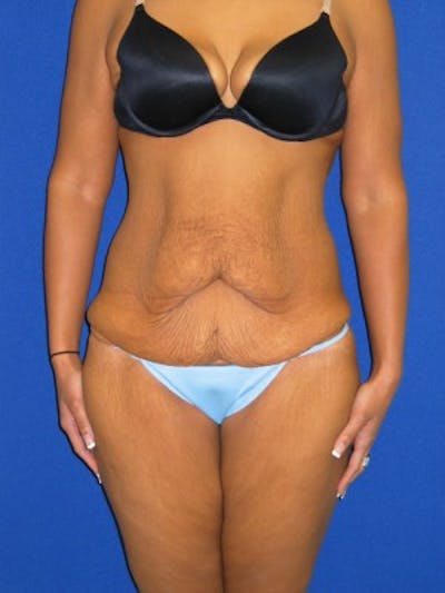 Abdominoplasty Before & After Gallery - Patient 175169411 - Image 1