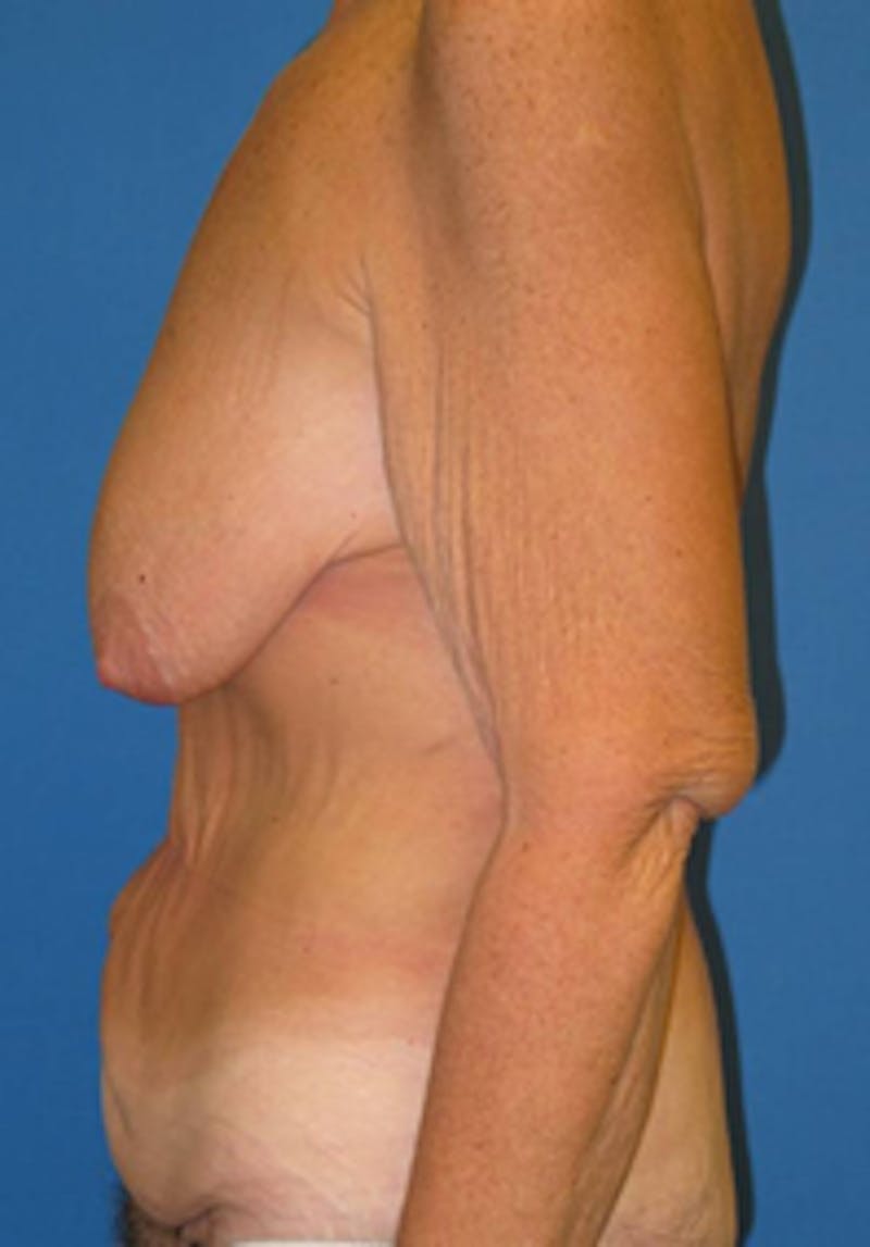 Circumferential Body Lift Before & After Gallery - Patient 175169406 - Image 3