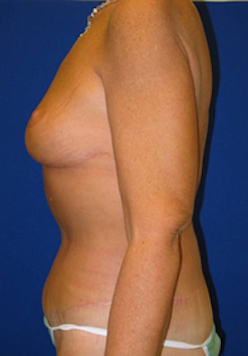 Circumferential Body Lift Before & After Gallery - Patient 175169406 - Image 4