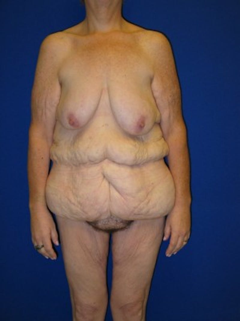 Extended Abdominoplasty Before & After Gallery - Patient 178931664 - Image 3