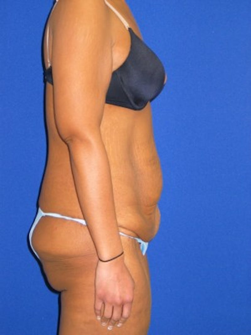 Abdominoplasty Before & After Gallery - Patient 175169411 - Image 3