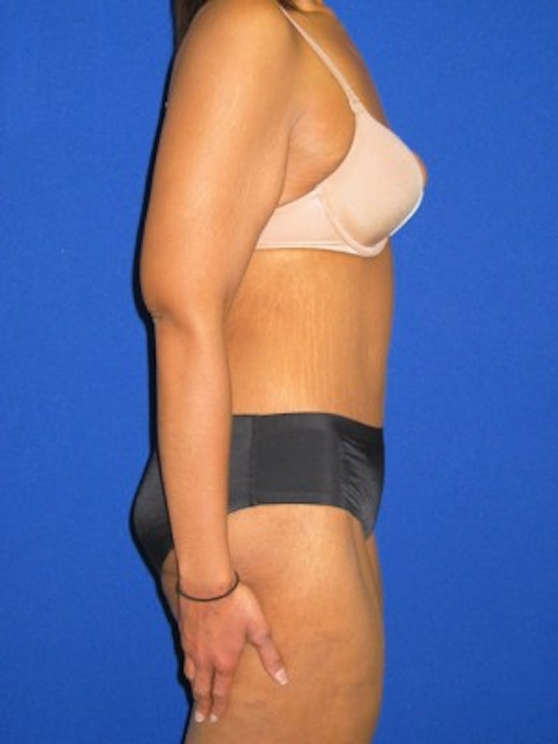Abdominoplasty Before & After Gallery - Patient 175169411 - Image 4