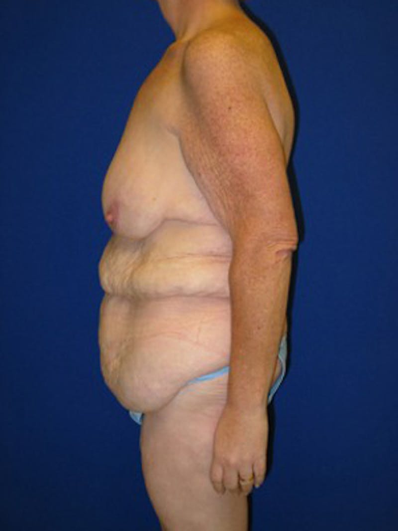 Extended Abdominoplasty Before & After Gallery - Patient 178931664 - Image 5