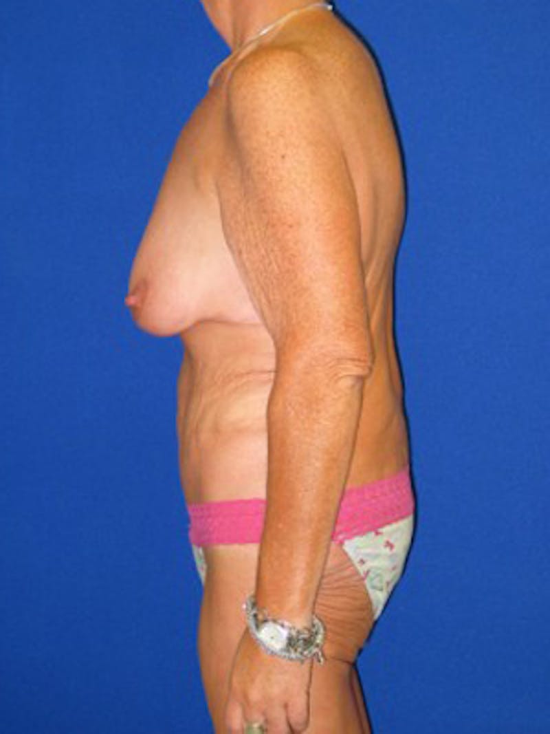 Extended Abdominoplasty Before & After Gallery - Patient 178931664 - Image 6