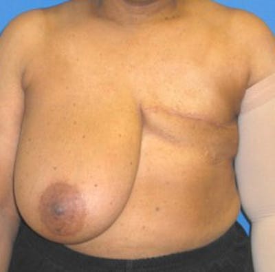 Reconstruction Before & After Gallery - Patient 175169422 - Image 1