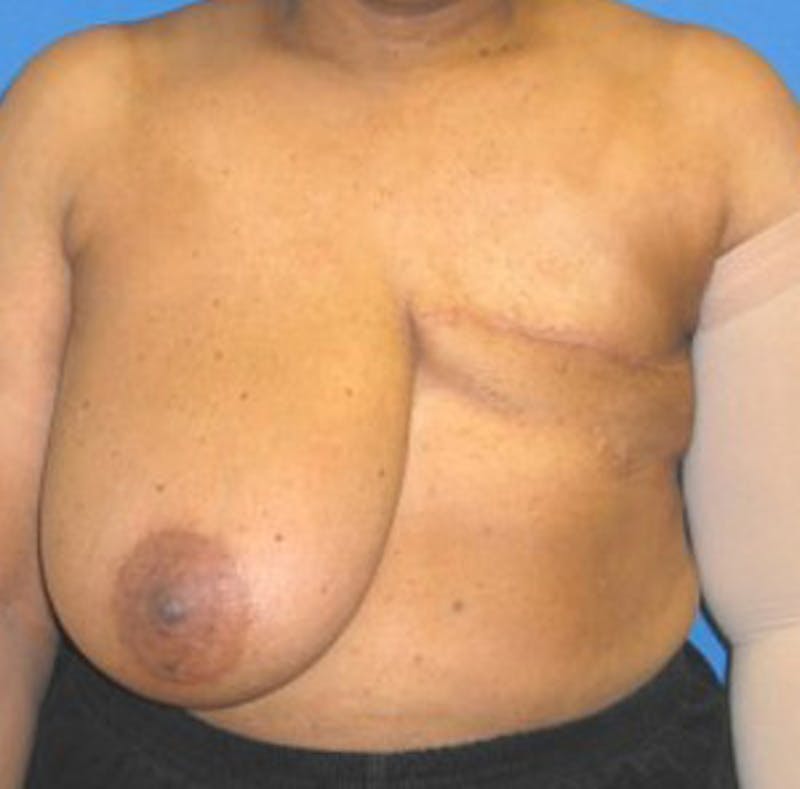 Reconstruction Before & After Gallery - Patient 175169422 - Image 1