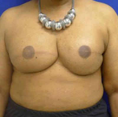 Reconstruction Before & After Gallery - Patient 175169422 - Image 2