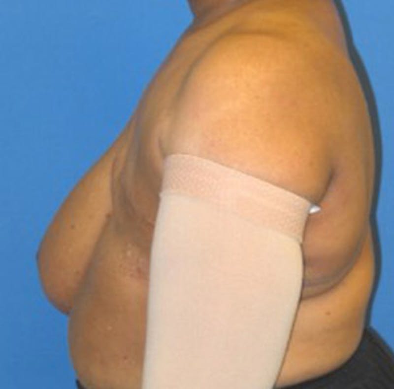 Reconstruction Before & After Gallery - Patient 175169422 - Image 3