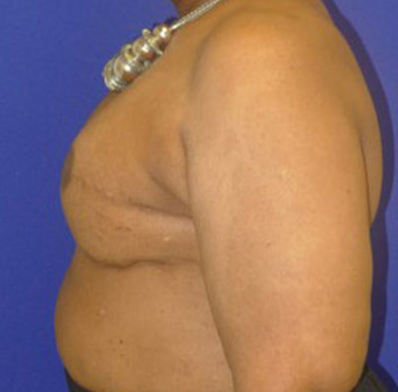 Reconstruction Before & After Gallery - Patient 175169422 - Image 4