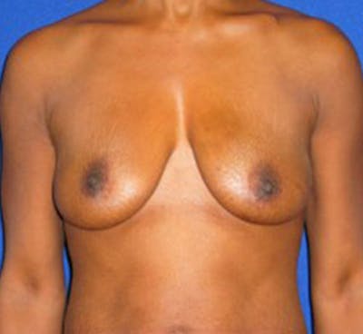 Reconstruction Before & After Gallery - Patient 175169425 - Image 1