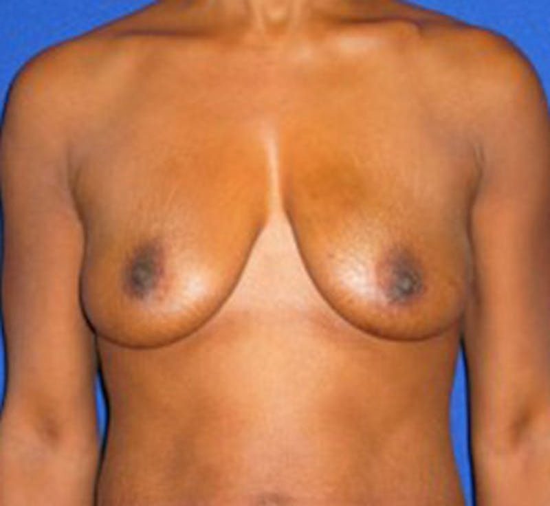 Reconstruction Before & After Gallery - Patient 175169425 - Image 1
