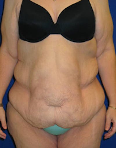 Circumferential Body Lift Before & After Gallery - Patient 175169434 - Image 1