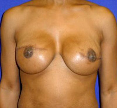 Reconstruction Before & After Gallery - Patient 175169425 - Image 2