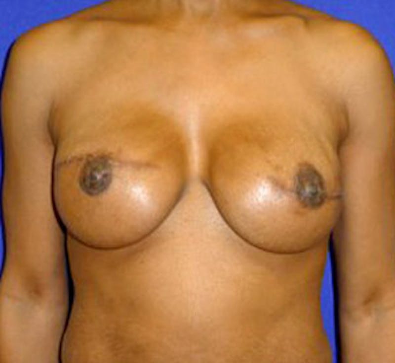 Reconstruction Before & After Gallery - Patient 175169425 - Image 2