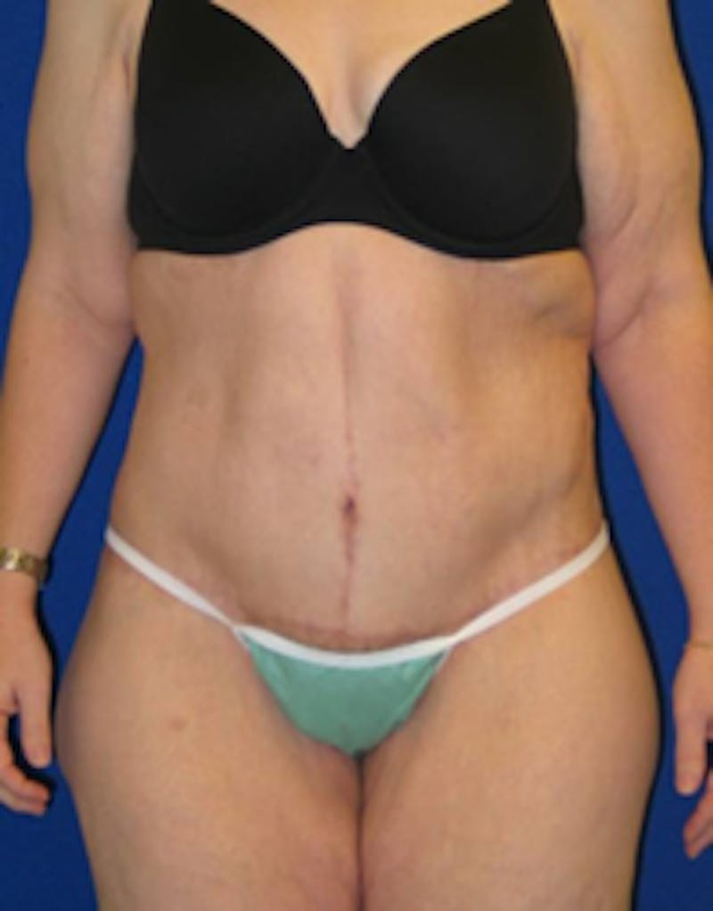 Circumferential Body Lift Before & After Gallery - Patient 175169434 - Image 2