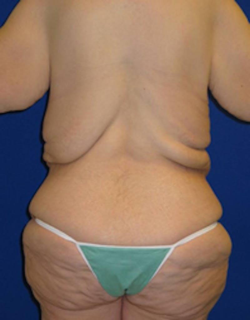 Circumferential Body Lift Before & After Gallery - Patient 175169434 - Image 3