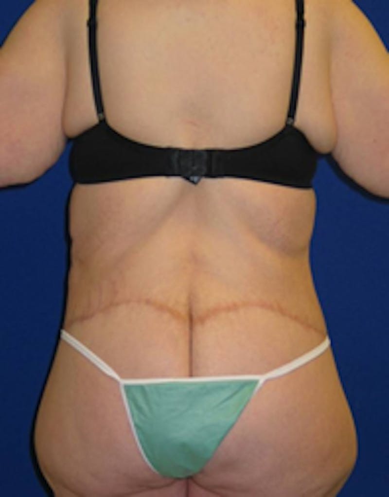 Circumferential Body Lift Before & After Gallery - Patient 175169434 - Image 4