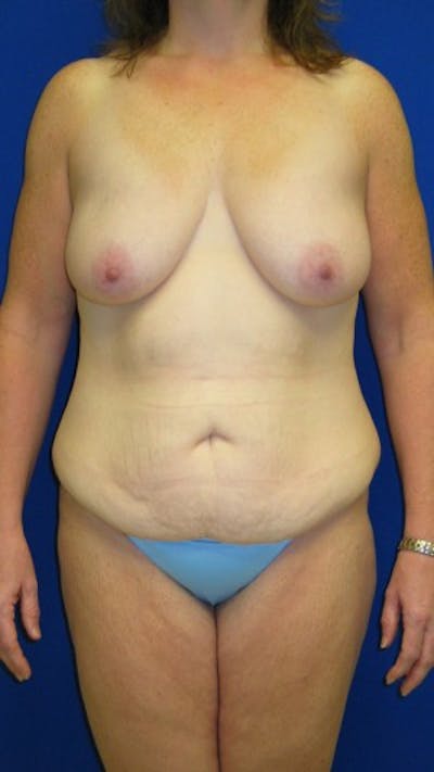 Breast Before & After Gallery - Patient 179735334 - Image 1