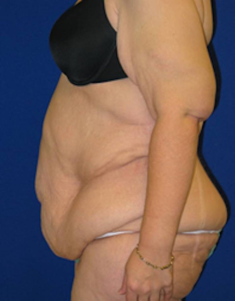 Circumferential Body Lift Before & After Gallery - Patient 175169434 - Image 5