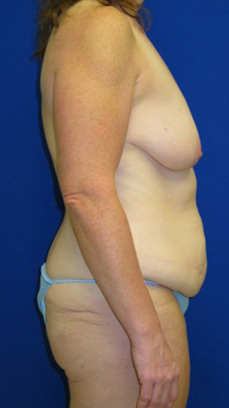 Extended Abdominoplasty Before & After Gallery - Patient 178931108 - Image 3