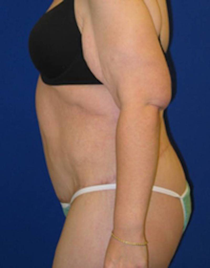Circumferential Body Lift Before & After Gallery - Patient 175169434 - Image 6