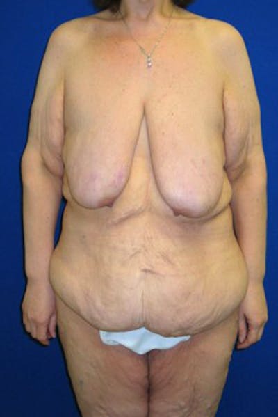 Panniculectomy Before & After Gallery - Patient 175169448 - Image 1