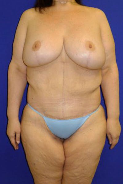 Panniculectomy Before & After Gallery - Patient 175169448 - Image 2